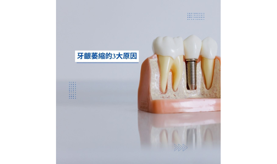 牙齦萎縮的3大原因